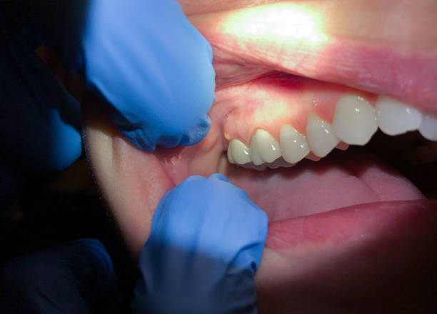 Best Cracked Tooth Emergency Dentist  in Vla Grove, IL